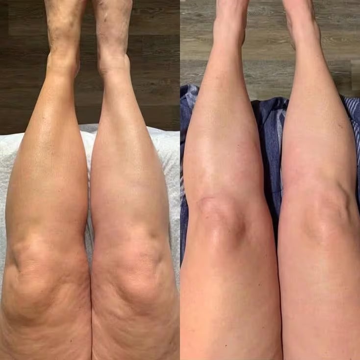 Avant/après Stéphanie C. — jambes dégonflées avec Lyphéa
